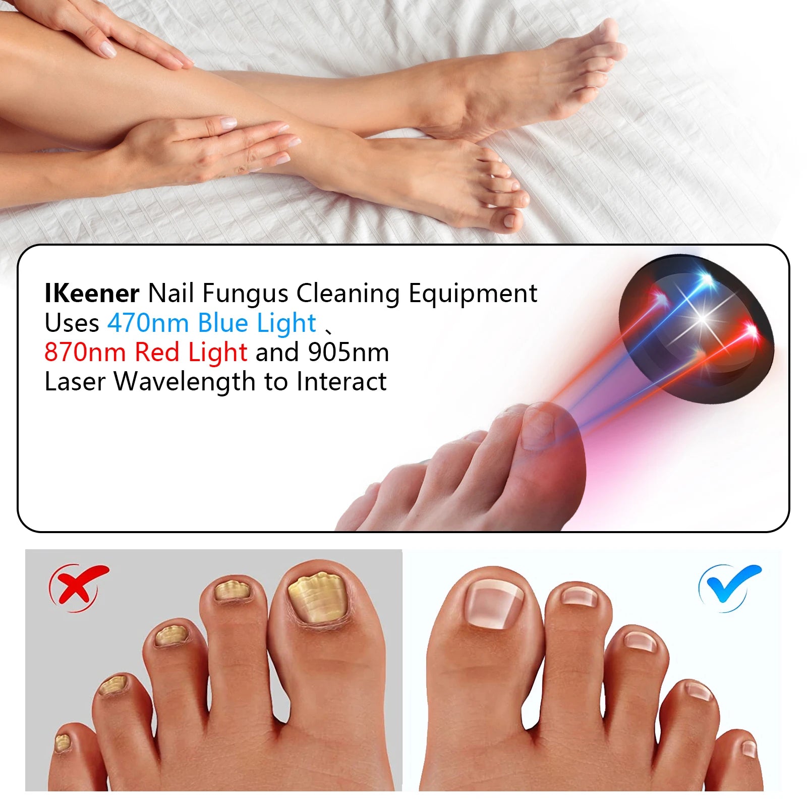 Fungal Nail Laser Device Repair Fast Nails Fungus Onychomycosis